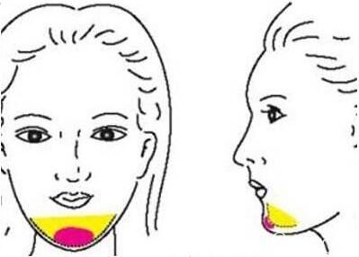 硅膠墊下巴會(huì)導(dǎo)致術(shù)后說(shuō)話不自然嗎？