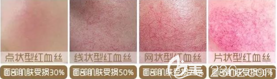 紅血絲的<span style= 紅血絲的<span style=