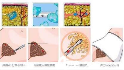 做腰腹吸脂術(shù)過程示意圖