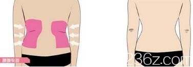 做腰腹吸脂效果展示