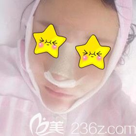 鼻綜合+脂肪填充面部術后1天效果