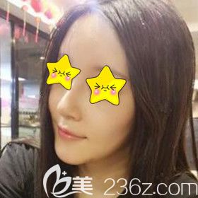 在愛德麗格做鼻綜合脂肪填充面部術后半個月恢復效果