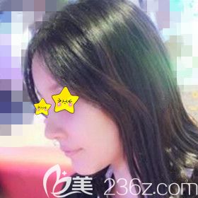 在大連做鼻整形+自體脂肪填充面部術后20天時的效果照