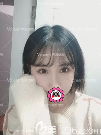 雙眼皮術后恢復一個月效果 雙眼皮術后恢復一個月效果