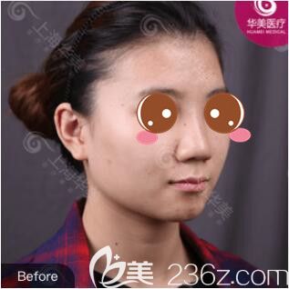 <!--<i data=20240703-sp></i>-->華美謝衛(wèi)國假體隆鼻真人案例術(shù)前照 <!--<i data=20240703-sp></i>-->華美謝衛(wèi)國假體隆鼻真人案例術(shù)前照