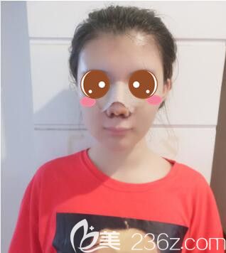 <!--<i data=20240703-sp></i>-->華美謝衛(wèi)國假體隆鼻真人案例術(shù)后第7天 <!--<i data=20240703-sp></i>-->華美謝衛(wèi)國假體隆鼻真人案例術(shù)后第7天