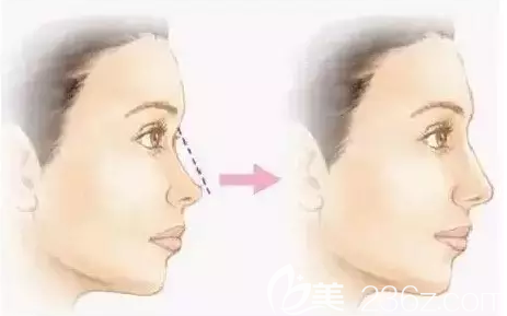 線雕隆鼻術(shù)后效果對(duì)比