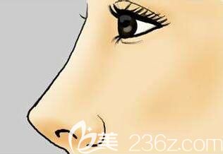 隆鼻材料假體如何選？