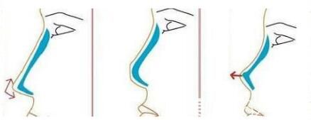 隆鼻材料硅膠和膨體那個(gè)更好