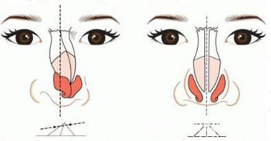 硅膠和膨體那個(gè)隆鼻材料能夠更好一點(diǎn)