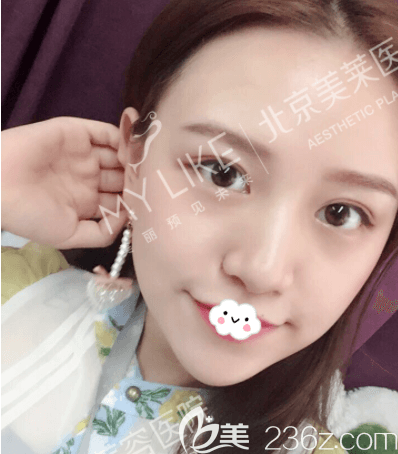 周福田醫(yī)生給我做玻尿酸墊下巴第7天效果