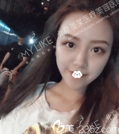 我在北京美萊做玻尿酸墊下巴第15天樣子