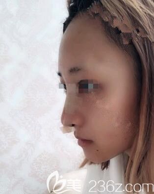 做完自體耳軟骨鼻綜合術(shù)后效果 做完自體耳軟骨鼻綜合術(shù)后效果