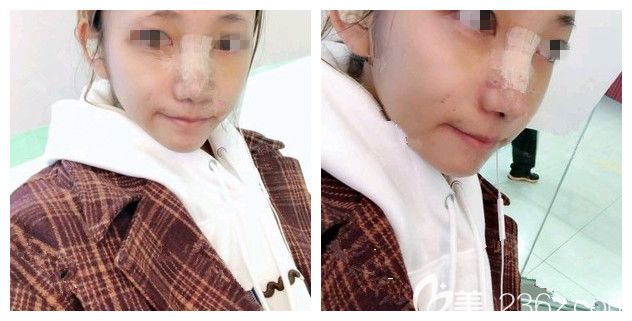 術(shù)后五天到南京韓辰復(fù)查自體軟骨隆鼻恢復(fù) 術(shù)后五天到南京韓辰復(fù)查自體軟骨隆鼻恢復(fù)