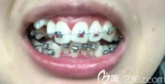 我在北京維嘉口腔剛戴牙套 我在北京維嘉口腔剛戴牙套