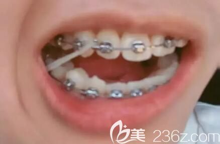 我在北京維嘉口腔做牙齒矯正1年效果 我在北京維嘉口腔做牙齒矯正1年效果