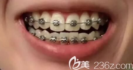 我在北京維嘉口腔戴金屬托槽1年半 我在北京維嘉口腔戴金屬托槽1年半