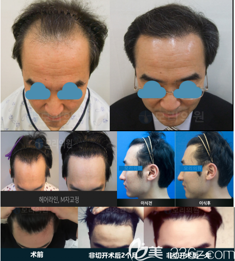 李尚郁院長(zhǎng)植發(fā)<span style=