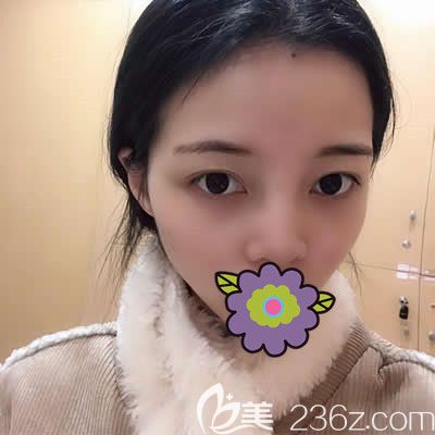 福州瑪恩陳意蕾為我做激光祛斑術(shù)后半個(gè)月照片