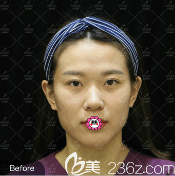 我在北京美萊做玻尿酸豐蘋果肌前樣子 我在北京美萊做玻尿酸豐蘋果肌前樣子