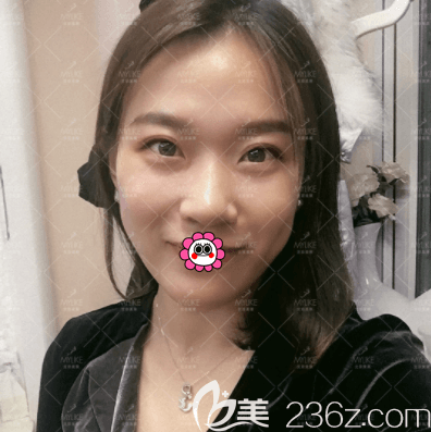 宋長緒醫(yī)生給我做玻尿酸豐蘋果肌第15天效果 宋長緒醫(yī)生給我做玻尿酸豐蘋果肌第15天效果