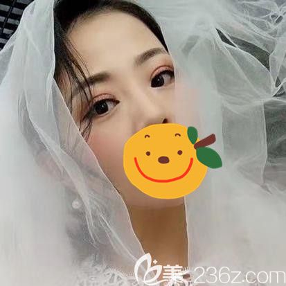 經(jīng)過了一場(chǎng)在駐馬店的眼部綜合手術(shù) 一個(gè)月后我的內(nèi)雙大小眼得到拯救