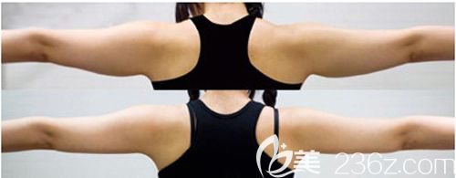 做手臂抽脂術(shù)前術(shù)后對(duì)比效果