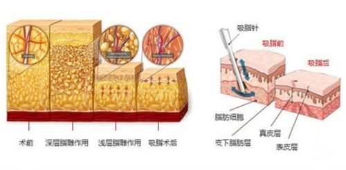 手臂吸脂減肥的手術(shù)步驟原理圖