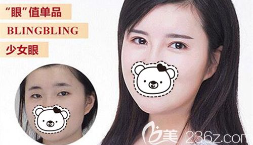 武漢藝星做精細切開雙眼皮術前術后對比