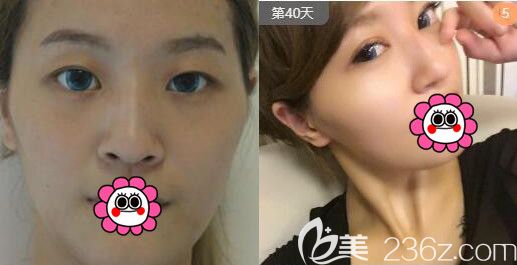 寧波雅韓劉成林雙眼皮案例 寧波雅韓劉成林雙眼皮案例