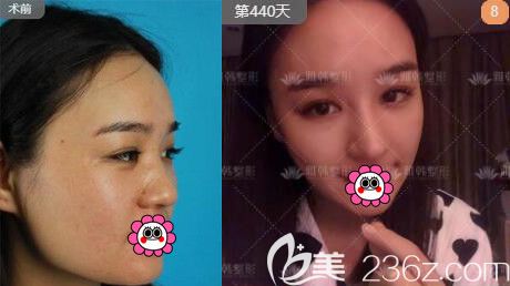 寧波雅韓龔濤隆鼻案例 寧波雅韓龔濤隆鼻案例