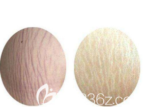 白色和紅色的妊娠紋