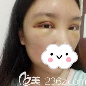 割雙眼皮術(shù)后第2天<span style=