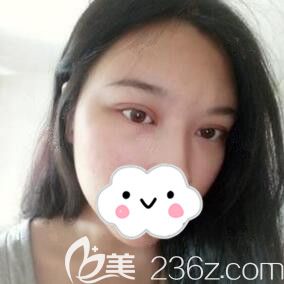 在懷化韓美割雙眼皮術(shù)后半個月<span style=