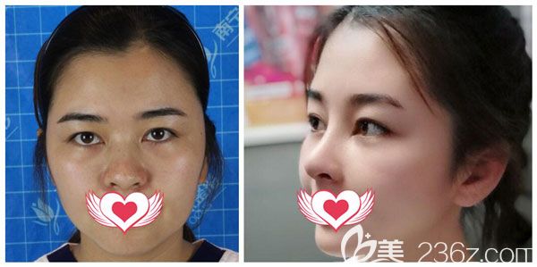 焦俊光院長做硅膠假體隆鼻+耳軟骨墊鼻尖案例