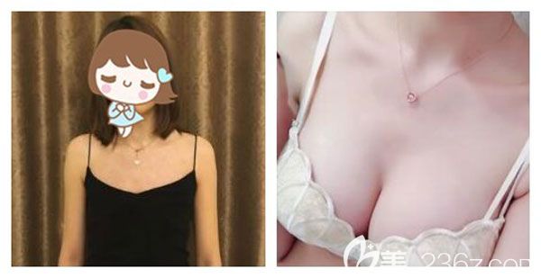 黎石峰做自體脂肪豐胸案例效果對比圖