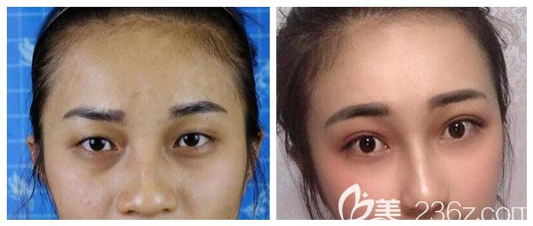 南寧美麗焦點祛眼袋+全切雙眼皮案例效果對比圖