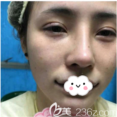 在深圳潤澤瑞尼絲做脂肪填充術(shù)前照片 在深圳潤澤瑞尼絲做脂肪填充術(shù)前照片