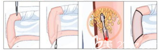 手臂抽脂過(guò)程圖