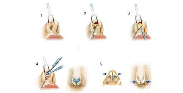 焦俊光醫(yī)生隆鼻三大優(yōu)勢