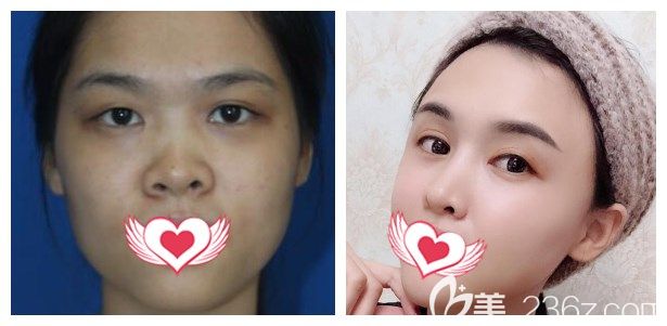 焦俊光做肋軟骨隆鼻+耳軟骨墊鼻尖案例效果對比圖