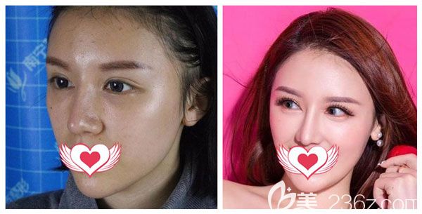 焦俊光院長做半肋鼻修復(fù)案例效果對比圖