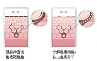 光子嫩膚治療原理
