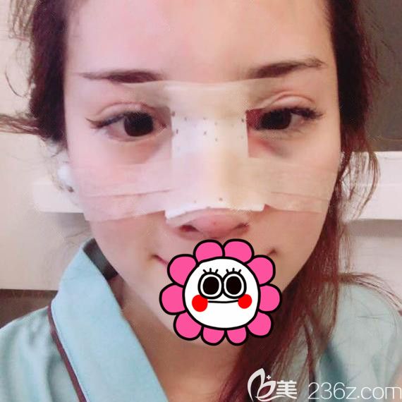 到寧波薇琳做完耳軟骨鼻綜合術(shù)后