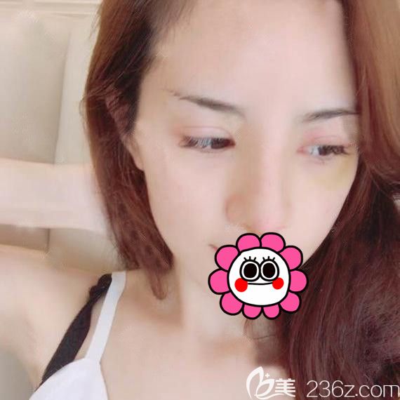 耳軟骨鼻綜合術(shù)后7天拆線后