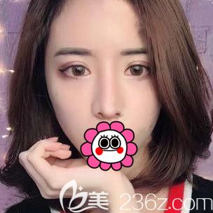 找寧波薇琳張廣巍做了耳軟骨隆鼻后我也加入了高顏值戰(zhàn)隊(duì)