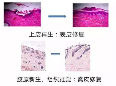 瘢痕的修復(fù)