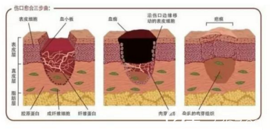 瘢痕愈合三部曲