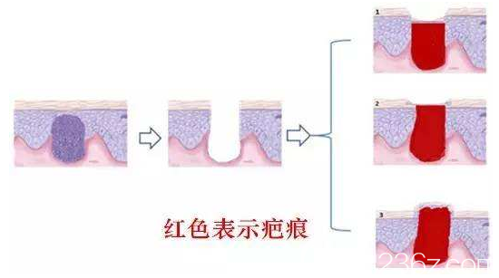 瘢痕恢復(fù)圖片