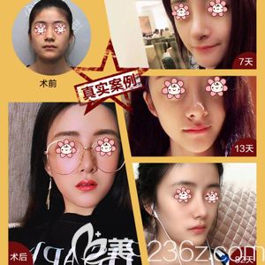 項利姣院長做自體脂肪面部填充移植術(shù)前術(shù)后效果對比 項利姣院長做自體脂肪面部填充移植術(shù)前術(shù)后效果對比